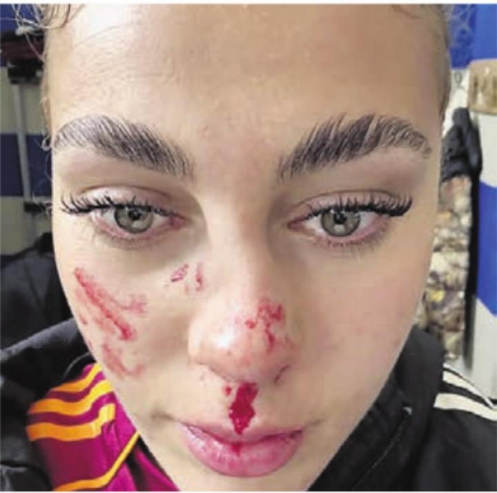 Nasenfraktur am Sonntag nach dem Spiel.